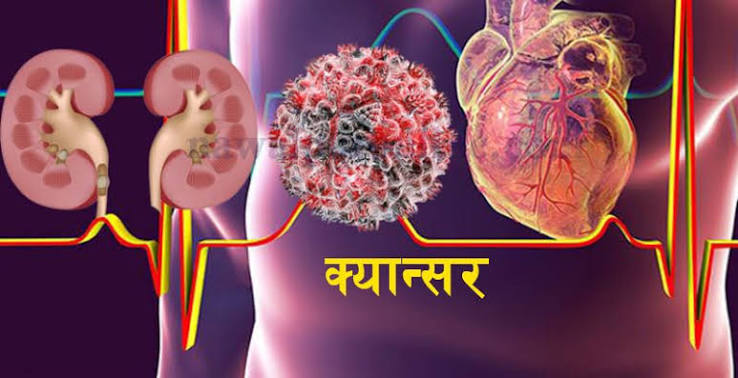 सन् २०५० सम्म विश्वभर क्यान्सरका नयाँ बिरामी ६७ प्रतिशतले बढ्न सक्ने